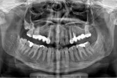 Zubný RTG